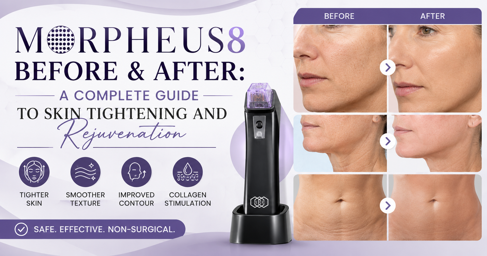 Morpheus8 Before & After: A Complete Guide to Skin Tightening and Rejuvenation