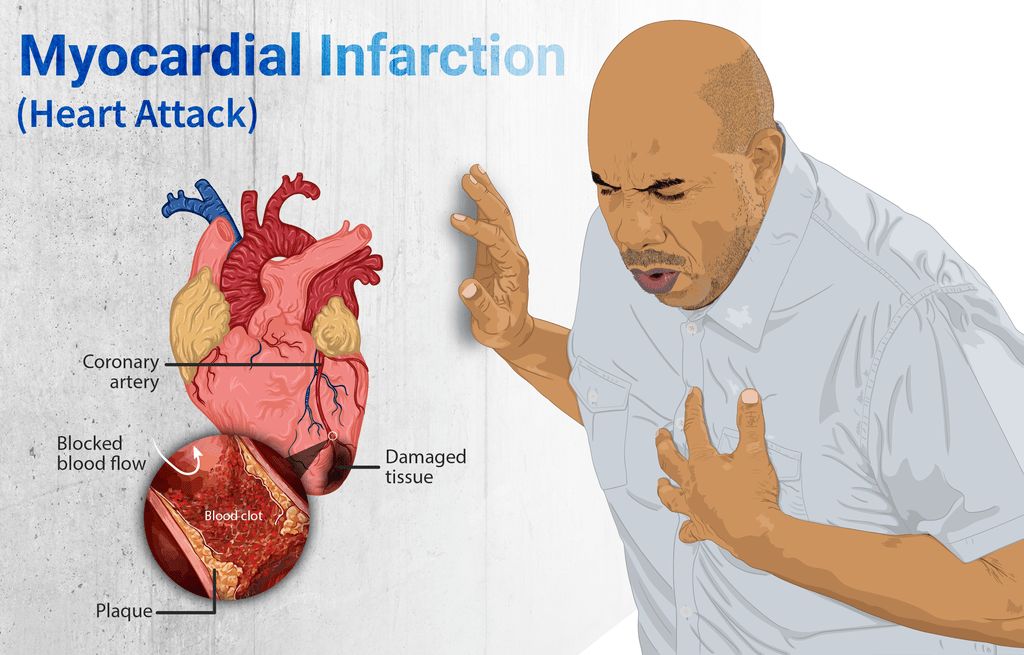 Understanding coronary artery disease icd 10 Myocardial Infarction Heart Attack