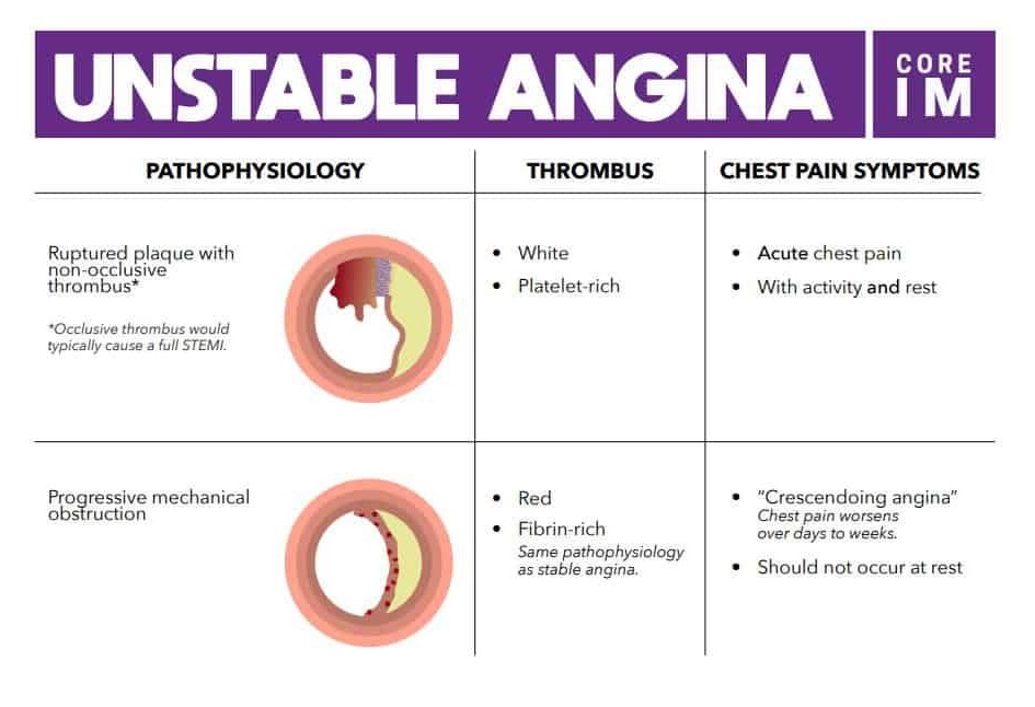 Understanding coronary artery disease icd 10 Unstable Angina