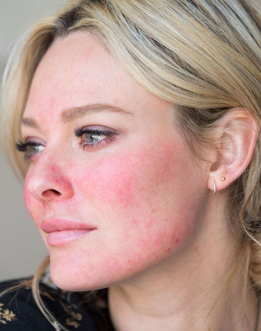 Autoimmune Skin Conditions