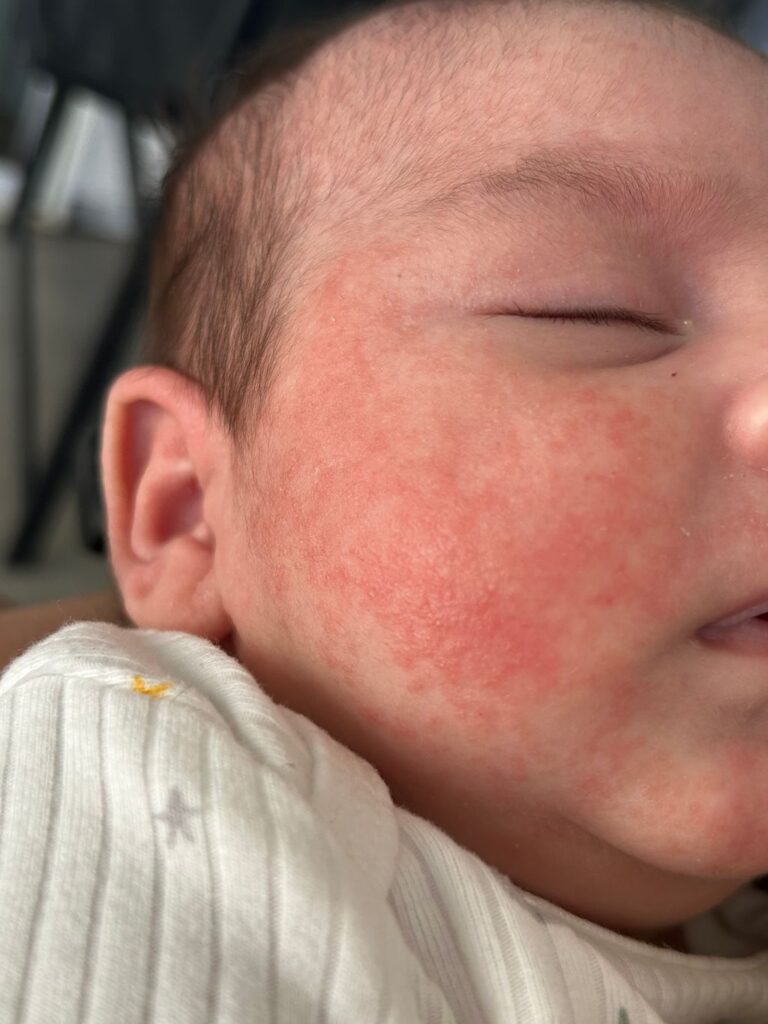 A Parent’s Guide to Baby Acne baby acne
