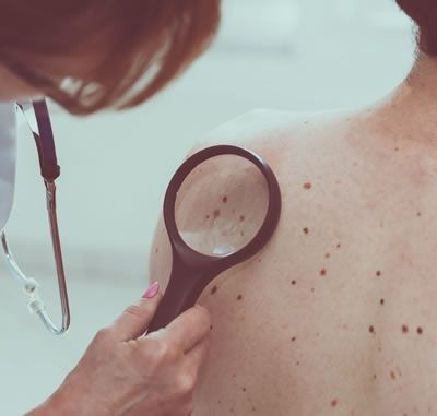 skin cancer removal