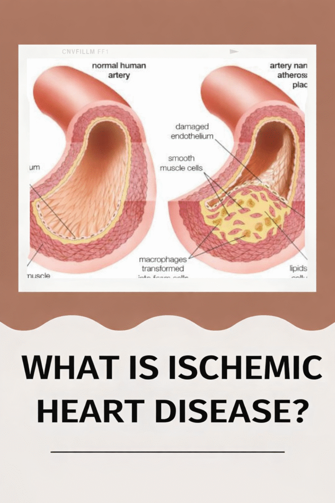 Complete Guide to ischemic heart disease icd-10 Codes (I20-I25) Chronic Ischemic Heart Disease 2 683x1024