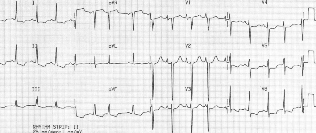Bi-Atrial Enlargement: A Comprehensive Review ecg biatrial enlargement