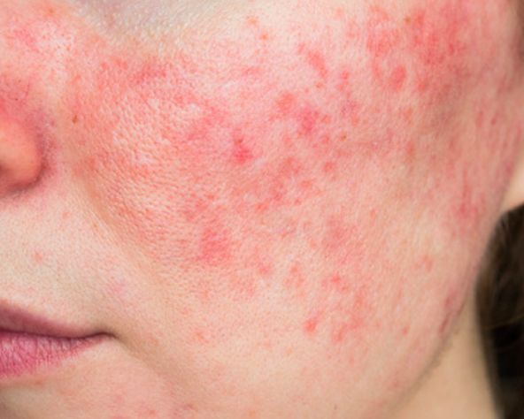 Redness Sensitive Skin: Common Causes and Triggers