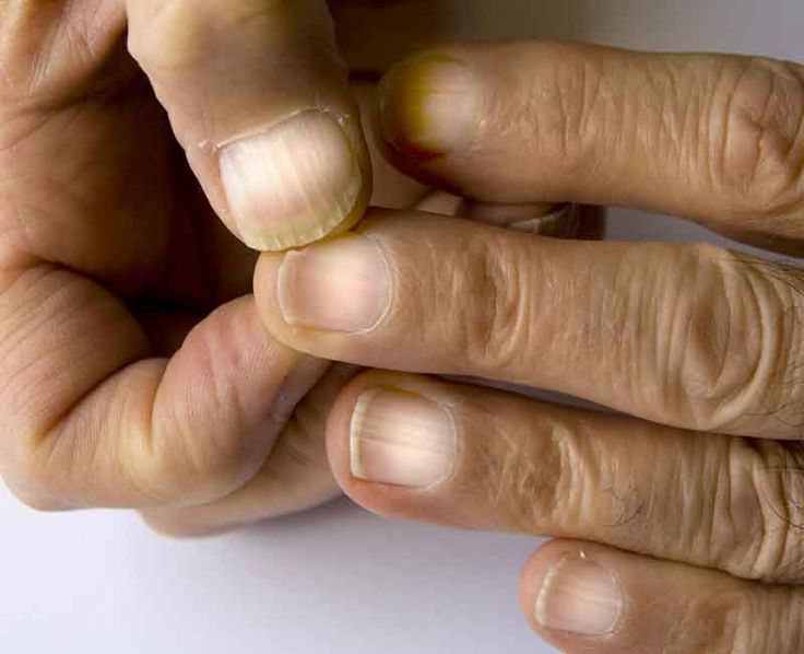 liver skin disease and Your: Signs, Symptoms, and Connections Terrys Nails