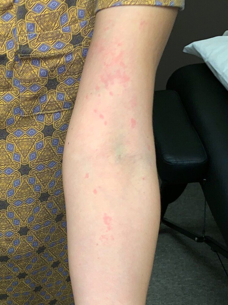 itchy skin liver disease