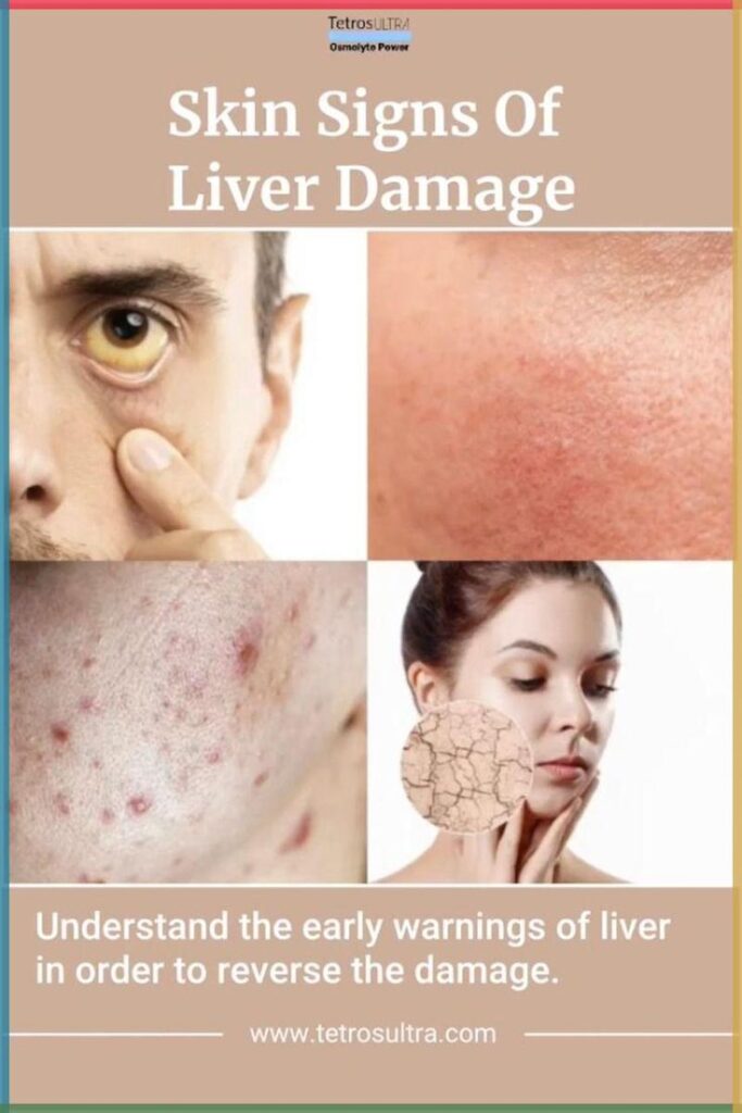 liver skin disease