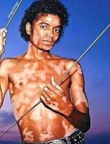 The True Story of michael jackson vitiligo Michael Jackson Vitiligo