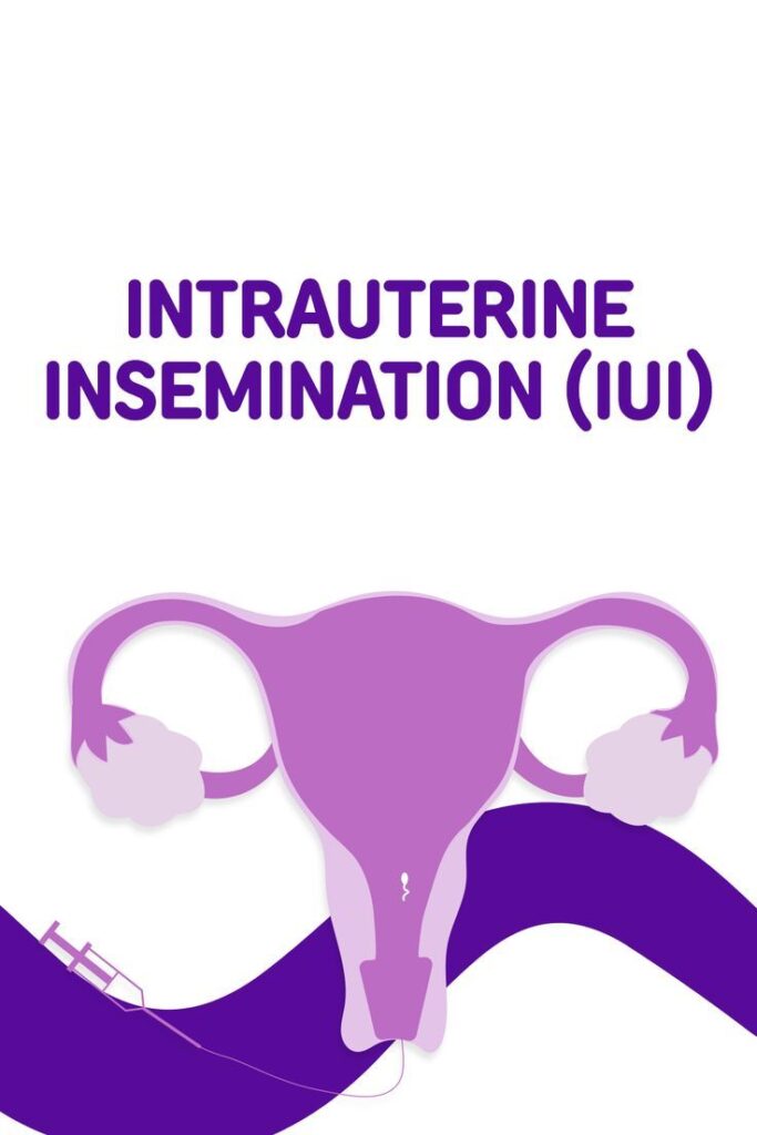 Artificial Insemination: A Complete Guide to the IUI Procedure iui